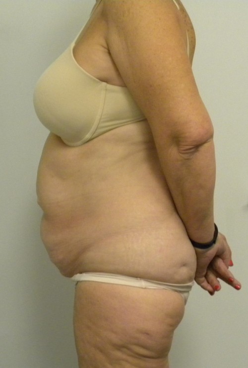 Tummy tuck (Abdominoplasty)