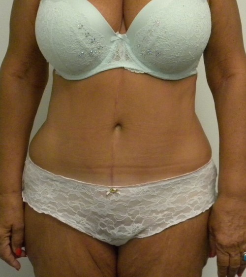 Tummy tuck (Abdominoplasty)