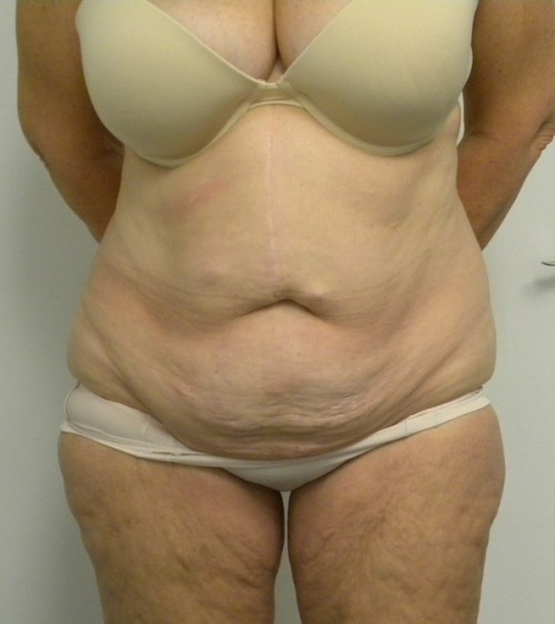 Tummy tuck (Abdominoplasty) Case 9169 Before Photo Tummy tuck (Abdominoplasty)