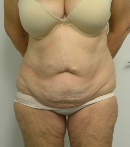 Tummy tuck (Abdominoplasty)