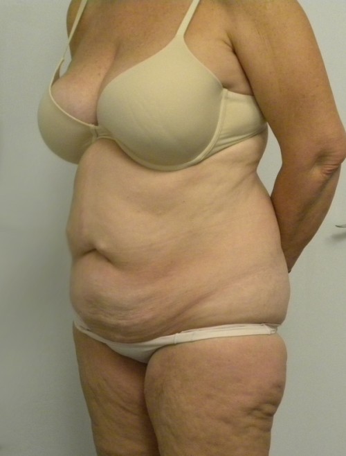 Tummy tuck (Abdominoplasty)