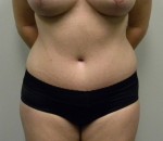Tummy tuck (Abdominoplasty)
