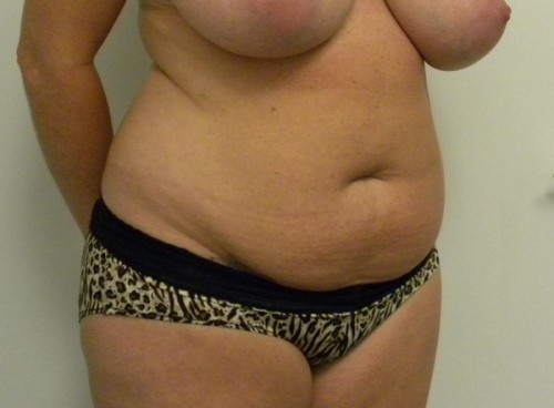 Tummy tuck (Abdominoplasty) Case 9185 Before Photo Tummy tuck (Abdominoplasty)