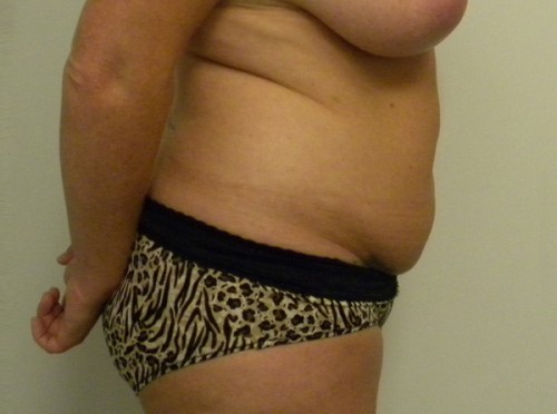 Tummy tuck (Abdominoplasty) Case 9185 Before Photo Tummy tuck (Abdominoplasty)