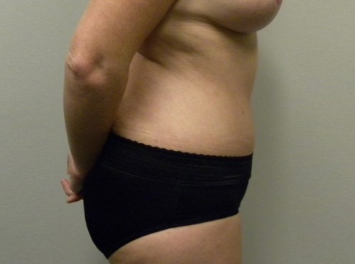 Tummy tuck (Abdominoplasty) Case 9185 After Photo Tummy tuck (Abdominoplasty)