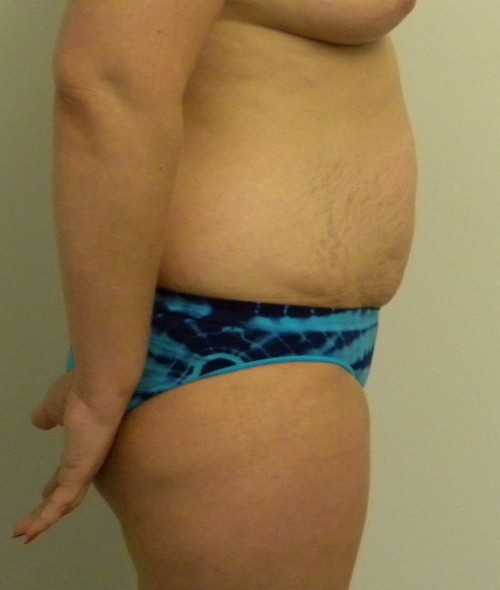 Tummy tuck (Abdominoplasty) Case 9209 Before Photo Tummy tuck (Abdominoplasty)