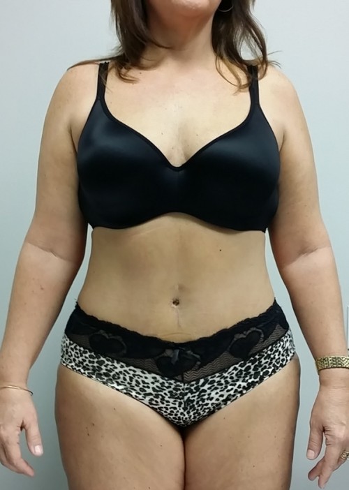 Tummy tuck (Abdominoplasty) Case 9217 After Photo Tummy tuck (Abdominoplasty)