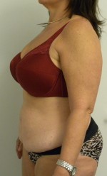 Tummy tuck (Abdominoplasty)