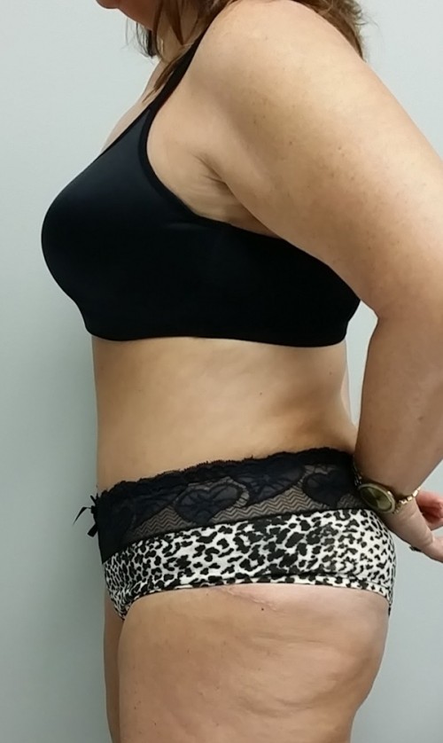 Tummy tuck (Abdominoplasty)