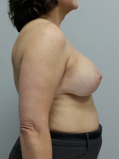 Breast Lift Case 9228 After Photo Breast Lift
