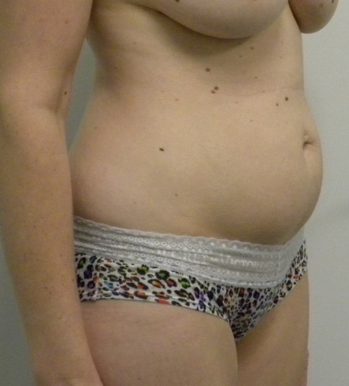 Tummy tuck (Abdominoplasty)
