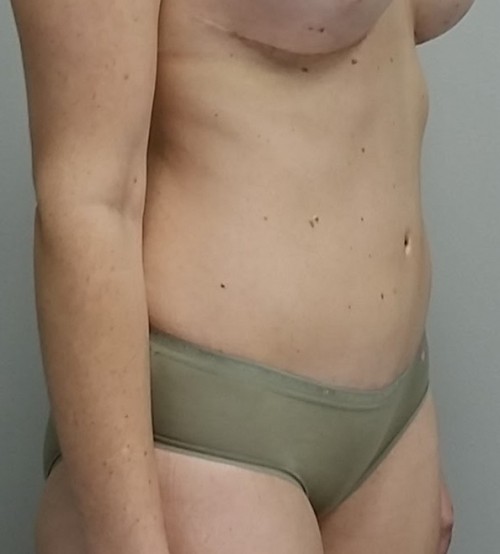 Tummy tuck (Abdominoplasty) Case 9240 After Photo Tummy tuck (Abdominoplasty)