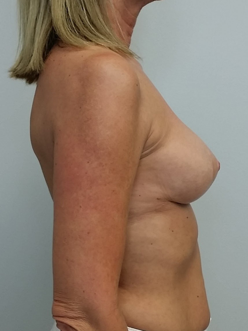 Breast Lift Case 9686 After Photo Breast Lift