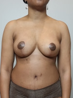 Breast Lift