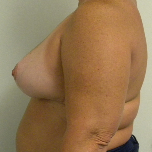Breast Reduction Case 9688 After Photo Breast Reduction