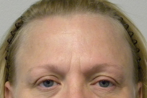 Brow Lift/Forehead Rejuvenation