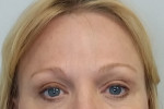 Brow Lift/Forehead Rejuvenation
