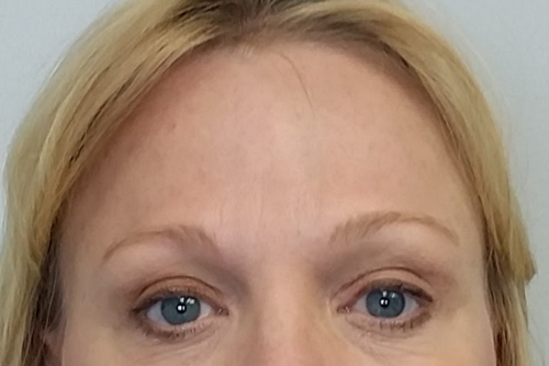 Brow Lift/Forehead Rejuvenation