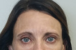 Brow Lift/Forehead Rejuvenation