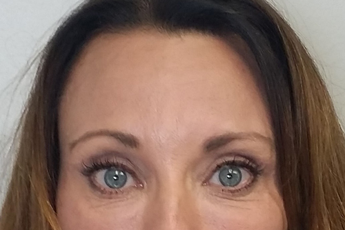 Brow Lift/Forehead Rejuvenation Case 9699 After Photo Brow Lift/Forehead Rejuvenation
