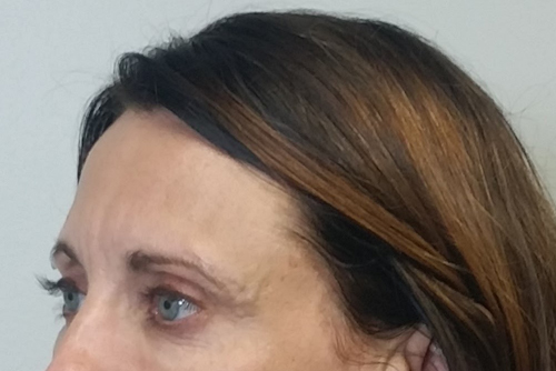 Brow Lift/Forehead Rejuvenation Case 9699 Before Photo Brow Lift/Forehead Rejuvenation