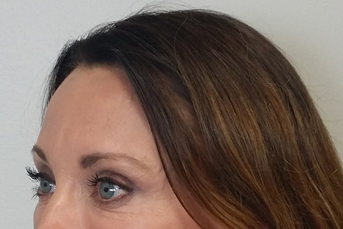 Brow Lift/Forehead Rejuvenation Case 9699 After Photo Brow Lift/Forehead Rejuvenation