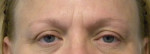 Eyelid Surgery