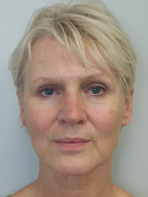 Facelift Case 9745 Before Photo Facelift