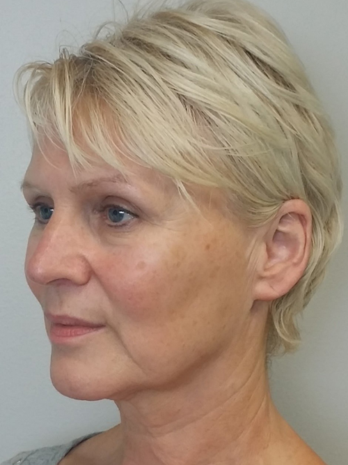 Facelift Case 9745 Before Photo Facelift