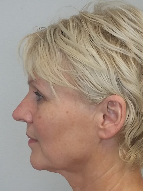 Facelift Case 9745 Before Photo Facelift