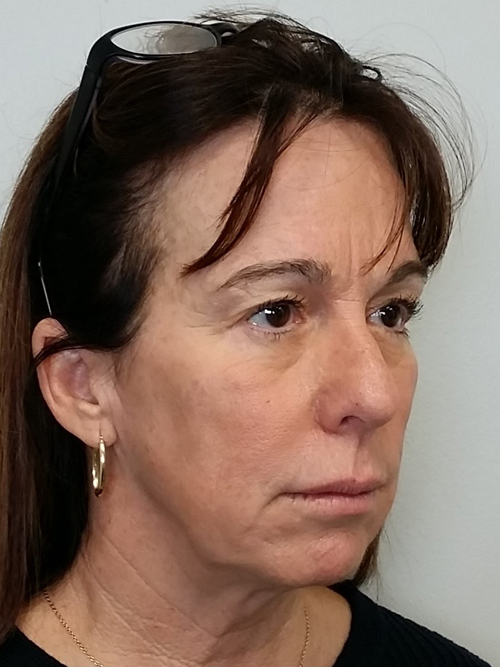 Facelift Case 9764 Before Photo Facelift