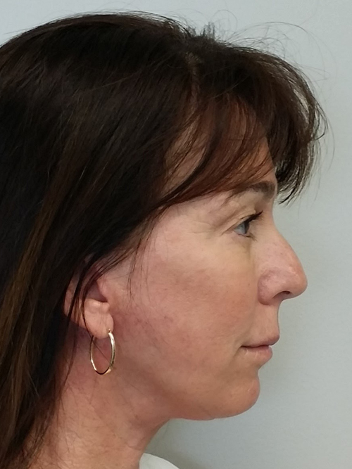 Facelift Case 9764 After Photo Facelift