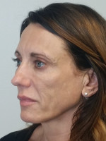 Facelift