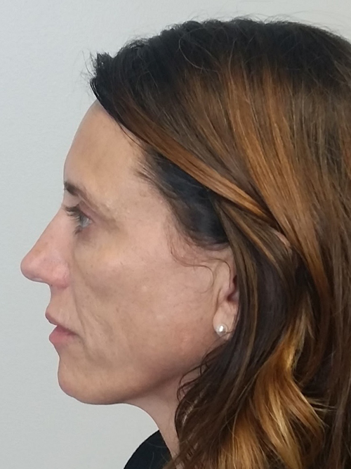 Facelift Case 9780 Before Photo Facelift