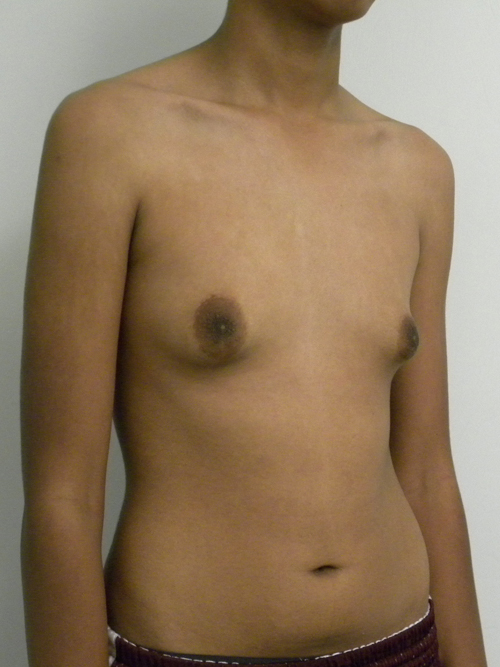 Gynecomastia Case 9798 Before Photo Gynecomastia