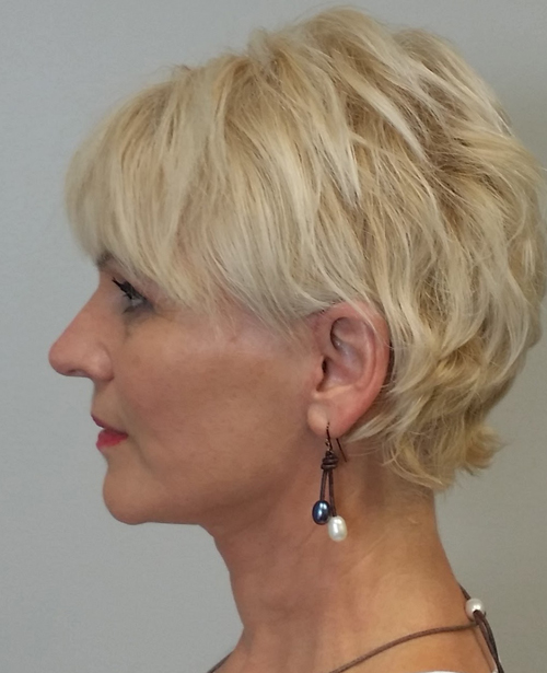 Neck Lift Case 9692 After Photo Neck Lift
