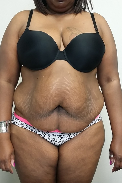 Tummy tuck (Abdominoplasty) Case 9701 Before Photo Tummy tuck (Abdominoplasty)