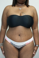Tummy tuck (Abdominoplasty)