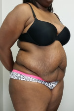 Tummy tuck (Abdominoplasty)