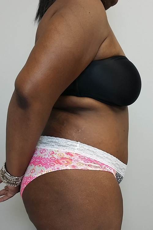 Tummy tuck (Abdominoplasty) Case 9701 After Photo Tummy tuck (Abdominoplasty)