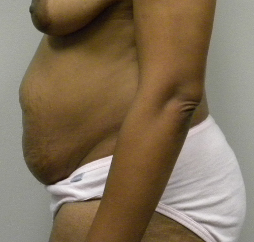 Tummy tuck (Abdominoplasty) Case 9747 Before Photo Tummy tuck (Abdominoplasty)