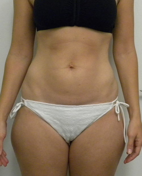 Tummy tuck (Abdominoplasty)