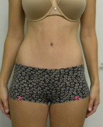 Tummy tuck (Abdominoplasty)