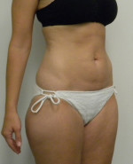 Tummy tuck (Abdominoplasty)