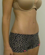 Tummy tuck (Abdominoplasty)