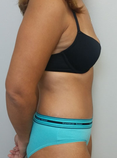 Tummy tuck (Abdominoplasty)