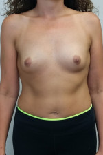 Breast Augmentation