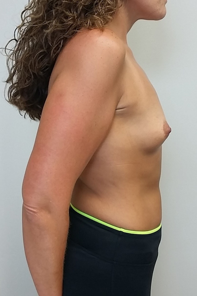 Breast Augmentation Case 9930 Before Photo Breast Augmentation