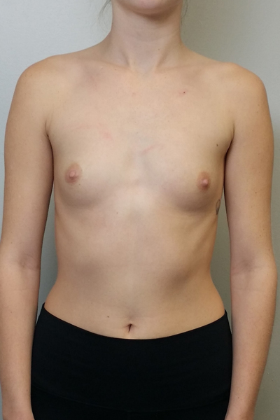 Breast Augmentation Case 10013 Before Photo Breast Augmentation