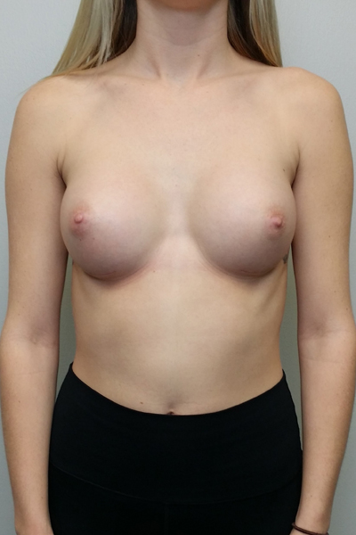 Breast Augmentation Case 10013 After Photo Breast Augmentation